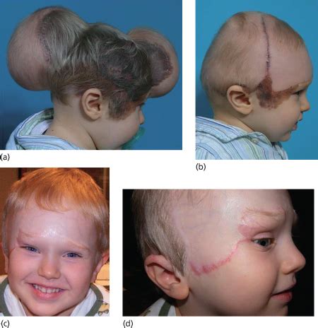 Children with red hair have more freckles but fewer melanocytic nevi: 191 Treatment of Congenital Melanocytic Naevi | Plastic ...