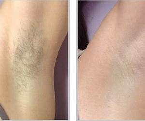 The remington ilight pro hair removal system is great for getting into smaller areas, especially on the. Laser Hair Removal Choices - Which Is Best For You ...