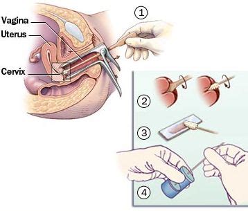 Oleh karena itu pencegahan harus dilakukan sedini mungkin agar sel kanker yang berada di serviks atau leher rahim ini bisa segera dideteksi. Sudahkah Anda Membuat Ujian Papsmear? :) | herneenazirdotcom