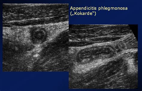 Diarrhoea and vomiting caused by gastroenteritis: KidsDoc.at: Bauchschmerzen-Appendicitis