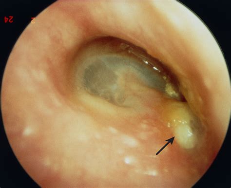 What is a middle ear infection? Ear Infection | Causes, Symptoms and Treatment