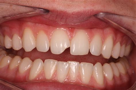 Composite Bonding and Improvement of Shape of Lateral Incisors - Linton ...