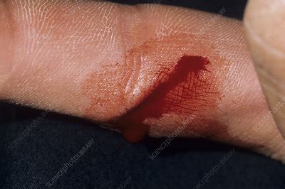 Finger laceration - Stock Image - M330/1195 - Science Photo Library