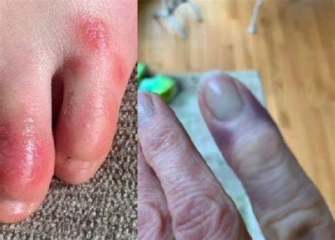 Some people are infected but don't. 'Covid toes or fingers' could be symptom of coronavirus ...