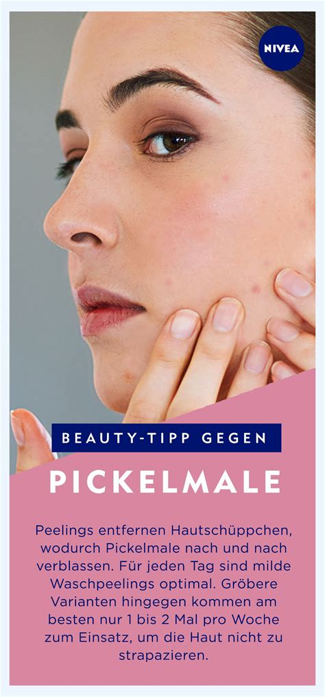 Tipps aus eigener erfahrung von redaktion und pickel am rücken nerven genauso wie pickel im gesicht: Der Pickel ist weg, doch es bleibt ein Fleck? Was ihr ...