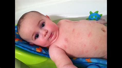 At this time, it's not clear if one. Baby Eczema | Baby Atopic Dermatitis | Eczema Dermatitis ...