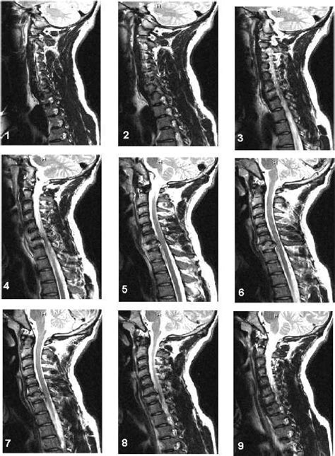 Magnetic resonance imaging (mri) of the cervical spine is a very commonly encountered test which can be performed for a variety of . Pin on Mri Scans