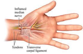 An example of this is when you hit your elbow and feel a tingling sensation in your little finger. the Dutch Touch - Bowen Therapy: Carpal Tunnel Syndrome