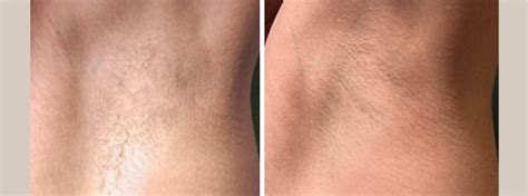 Our team of professionals at laser duet med spa offer a wide range of med spa services including laser fat removal, cosmetics, teeth whitening, smart liposuction, microdermabrasion and much more! LightSheer DUET Treatments Mountain View - Laser Hair Removal