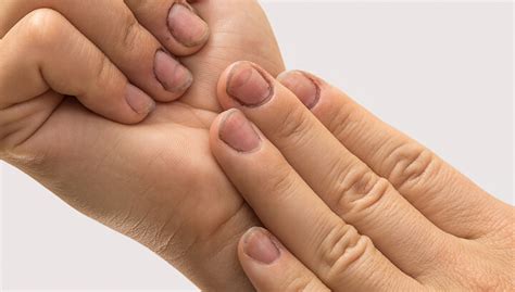 Horizontal ridges on nails may also indicate a thiamine, vitamin b1 deficiency. What Your Fingernail Lines Say About Your Health