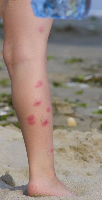 Humecta la piel.la crema hidratante sella la piel para evitar que el agua se escape. Tiñas en los niños