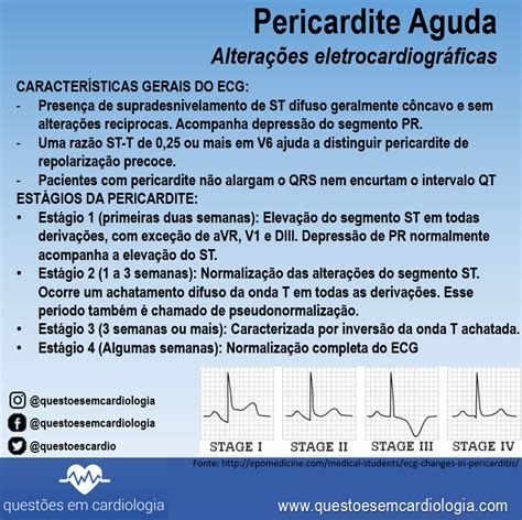 Em sua fase inicial, pode ter uma elevação côncava do st em quase todos as derivações (exceto avr), com a depressão do segmento pr (veja pericardite aguda). ECG com supra de ST em jovem: qual o provável diagnóstico ...