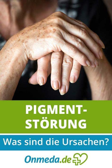 Pigmentstörungen vor wird dies in der medizin auch als abnorme pigmentierung der haut bezeichnet. Pigmentstörung | Hautkrankheiten, Erkrankungen ...