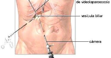 Atualmente sabemos que essa doença pode afetar também o cólon (intestino grosso), dando lugar a uma condição conhecida como colite granulomatosa (granuloma são lesões microscópicas que se encontram na parede intestinal de pacientes de doença de crohn). Sabe o que é laparoscopia? Saiba mais sobre essa cirurgia ...