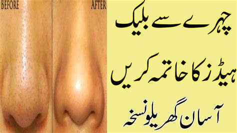 I m a married women dates ane se pehley check kia wait ni kia missing periods ka so mera result negative ayaa par. Blackheads Khatam Karne Ka Tarika | Asan Gharelu ilaj - Pimples Treatment in Urdu - YouTube