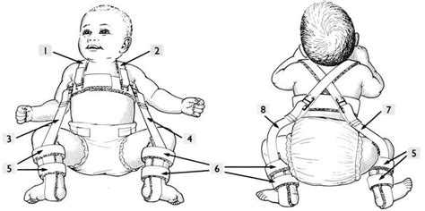 Pavlik Harness Tips - Infant Hip Dysplasia | International ...