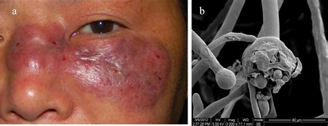 Mucormycosis, also known as black fungus, is a serious fungal infection, usually in people with reduced ability to fight infections. Unusual Parasitic and Fungal Infections: Mucormycosis ...