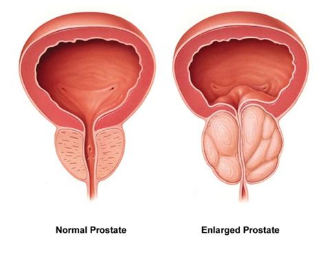 If cancer has spread outside of the prostate gland. The 10 Most Relevant Signs & Symptoms of Prostate Cancer!
