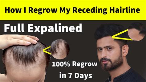 If you're interested in stopping your receding hairline long term , blocking dht always needs to be part of your strategy. How I Regrow My Receding Hairline Naturally at Home ...