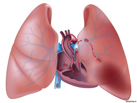 Plicní embolie je vmetení krevních sraženin do plicních cév a jejich uzávěr. Plicní embolie