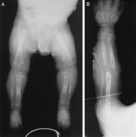 Early disease usually presents before 3. A, Diffuse periostitis and demineralization of long bones ...