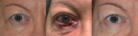 Kahng is focused on providing the most desired results with as little our skilled plastic surgeons at cara plastic surgery & laser center in los angeles can tailor an reasons to have cosmetic eyelid surgery. Oculoplasty-Surgery-Procedure-Los-Angeles | Taban MD ...