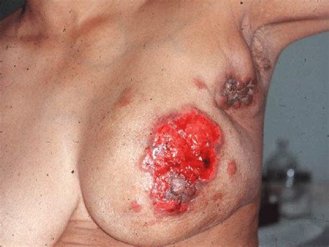 At this time there aren't many strong. BREAST CANCER, Sleek Articles