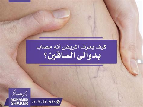 علاج قشرة الرأس وتساقط الشعر في أقل من 7 أيام. علاج دوالى ااساقين دكتور مازن السقا - Ø¹Ù„Ø§Ø¬ Ø¯ÙˆØ§Ù„ÙŠ ...