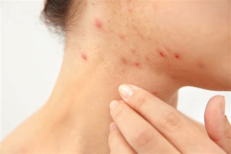 What is the treatment for itching? Scabies: Symptoms, Causes and Treatment - Natural Food Series