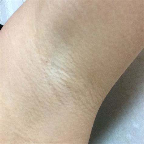 脇の脱毛クリームで黒ずみは改善されるのだろうか？ - 脇毛が ...