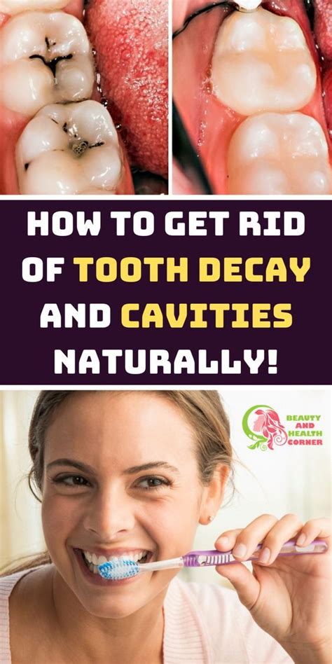 While cavities can't be healed at home, they can be treated by a dental professional. How To Get Rid Of Cavities And Tooth Decay | Dental decay ...