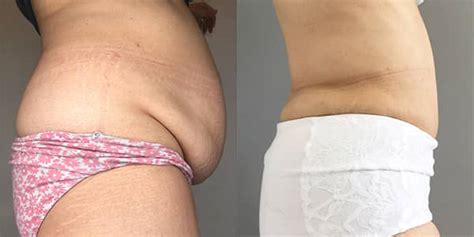 Full business details, opening hours, map and directions, website link, address and phone number for 111 harley st. Tummy Tuck Surgery and Treatments from 111 Harley St.