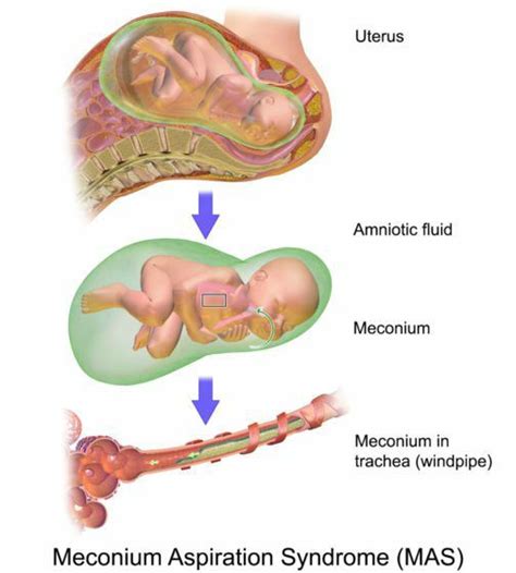 Punca sakit tekak yang paling biasa berlaku di malaysia ialah kerana jangkitan oleh bakteria streptococcal. Betul Ke Bayi Menelan Air Ketuban Masa Lahir Penyebab ...