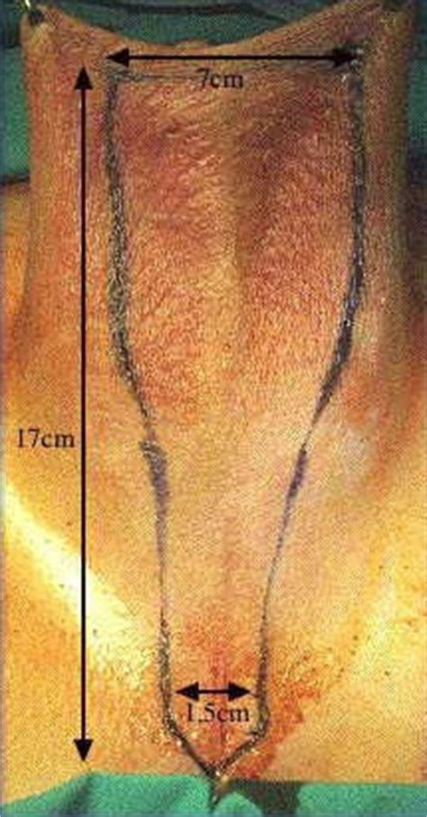 There is more advancement being made outside these limitations especially with hybrid devices. Hair removal | GenderXchange