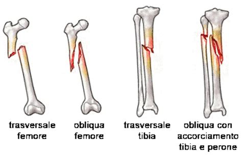 S. O. S. - "Osteomielitici d'Italia" - Onlus: (Scheda 112 ...