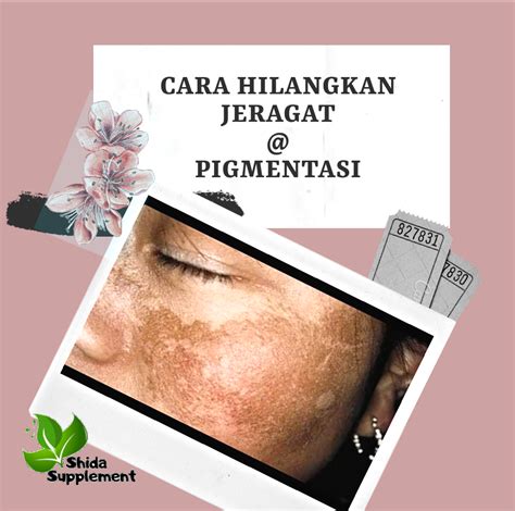 Cara menghilangkan jerawat pun bervariasi, yaitu bisa dilakukan secara alami maupun dengan cara medis seperti. Cara Hilangkan Jeragat@Pigmentasi ~ shidarahmat