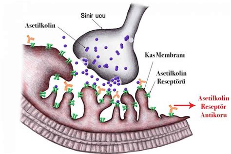 Up to 80% of functional receptors loss; Myastenia Gravis Nedir? En Sık Belirtileri, Nedenleri ...