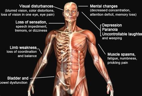 You may have just one symptom in one part of your body, or several symptoms in different parts of your body. Multiple Sclerosis Symptoms Picture Image on RxList.com