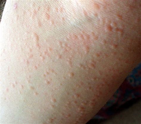 You can often treat hives yourself. Cold Urticaria - Pictures, Treatment, Symptoms, Causes