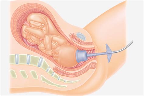 Diese babyschalen müssen immer entgegen der. Vacuum Assisted Delivery: Was ist das und wie wird es ...