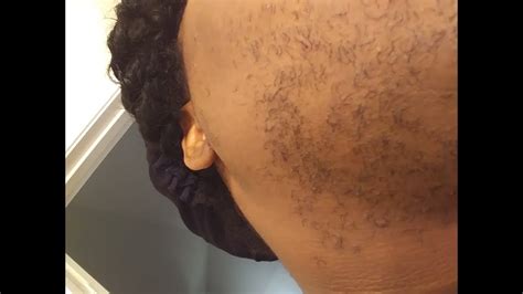 Today's medical electrolysis devices destroy the growth center of the hair with chemical or heat energy. Electrolysis Hair Removal - YouTube