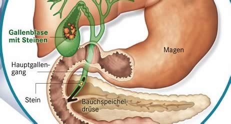 Symptome, behandlung und operation, wann muss man sie entfernen? Gallensteine (Cholelithiasis) | Apotheken Umschau