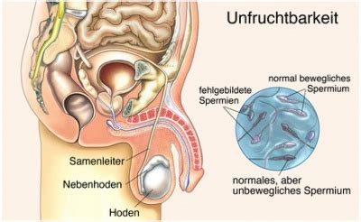 Wann ist die fruchtbarkeit am. Unfruchtbarkeit und Zeugungsunfähigkeit beim Mann ...