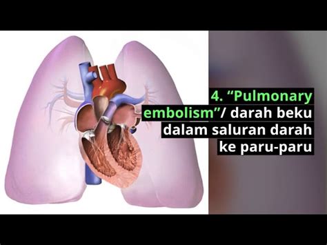 Kondisi ini menimbulkan rasa nyeri yang muncul baik di sebelah kanan maupun di sebelah kiri bagian belakang. Penyebab Dada Kanan Sakit Saat Tarik Nafas - Berbagai Sebab