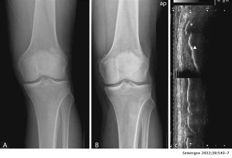 #foamed #foamrad #radiology #rad #elearnrad #voxelz #varunbabu #drbabu. Síndrome de Pellegrini-Stieda como causa de gonalgia ...