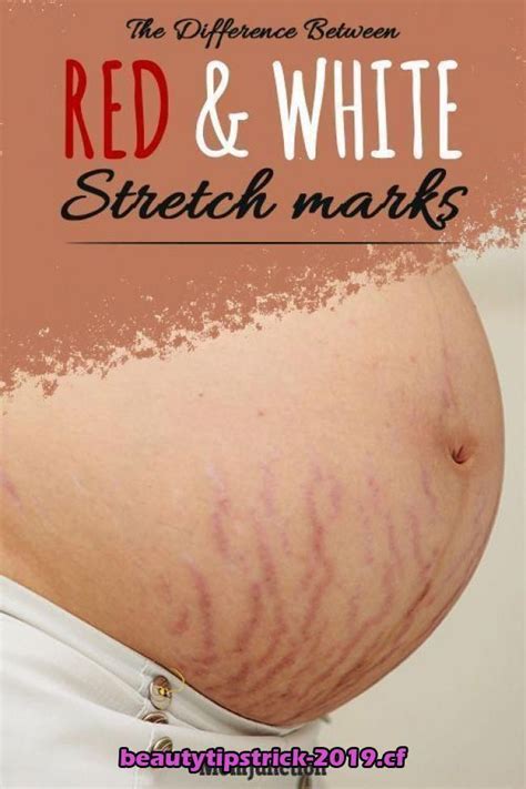 Natural creams and oils, like cocoa butter or coconut oil, work wonders in keeping the skin smooth. Pin on Stretch Marks Remedies