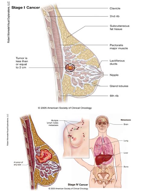 You will probably need an antibiotic, and you need to have inflammatory breast cancer. Breast Cancer