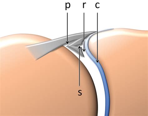 I've just switched over to this diagram here and we're looking at the same view, a lateral view of the right shoulder. Imaging the Glenoid Labrum and Labral Tears | RadioGraphics