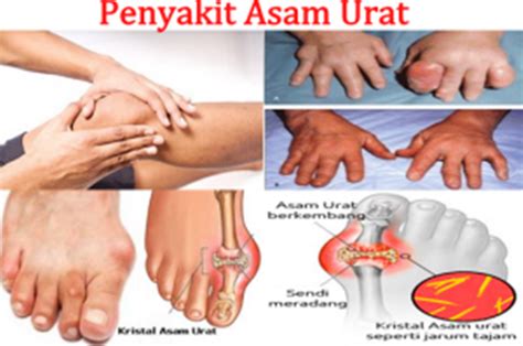 Penyebab asam urat tinggi selain makanan juga bisa dari faktor eksternal yang tidak bisa anda duga sebelumnya. Berapa Lama Penyakit Asam Urat Bisa Sembuh