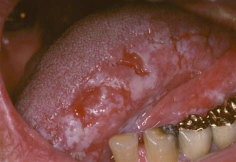 Albicans can cause or colonise other keratoses, particularly in smokers leukoplakia, especially of the dorsum of tongue, is a feature of tertiary syphilis but is rarely seen now. Oral Hairy Leukoplakia - Pictures, Causes, Treatment, Symptoms